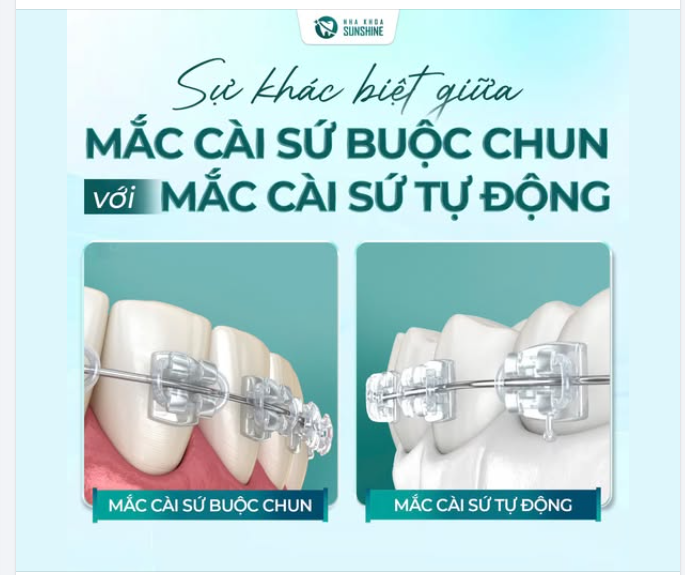 Nhiều bạn hỏi nha khoa: "Mắc cài sứ có loại tự buộc (tự động) giống mắc cài kim loại không?"