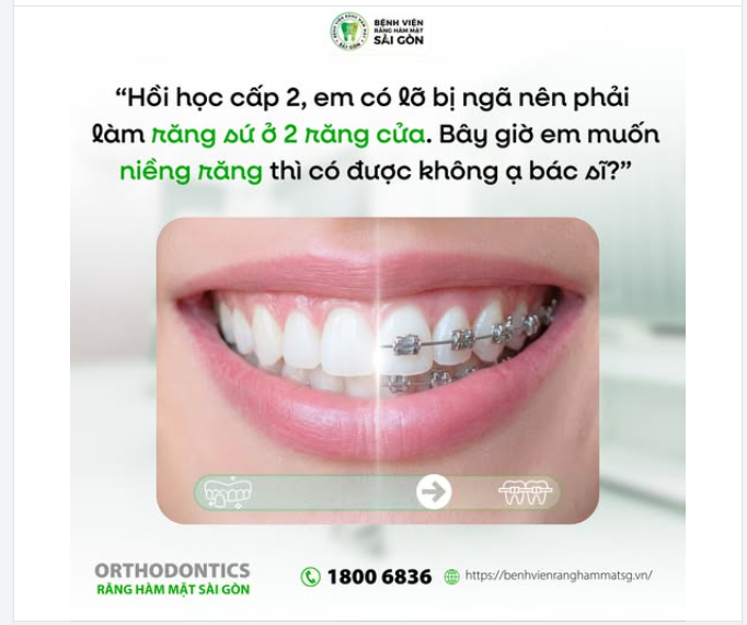 “Bác sĩ ơi, lúc học cấp 2 em từng bị 'ngã' nên đã làm răng sứ 2 răng cửa. Bây giờ em muốn niềng thì có được không ạ?”