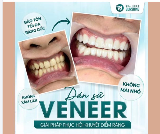 Vì cụm “Dán Sứ Không Mài” thường là cách nói rút gọn để quảng bá, chứ không phải lúc nào cũng đúng tuyệt đối.