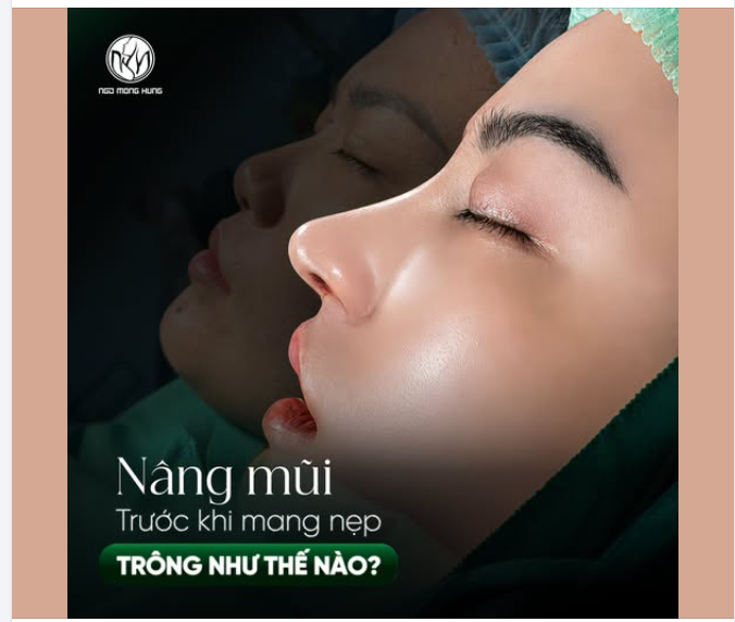 Nâng mũi cấu trúc trước khi mang nẹp trông như thế nào?