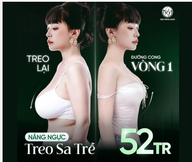 Treo lại đường cong V1  Nâng ngực sa trễ 52TR