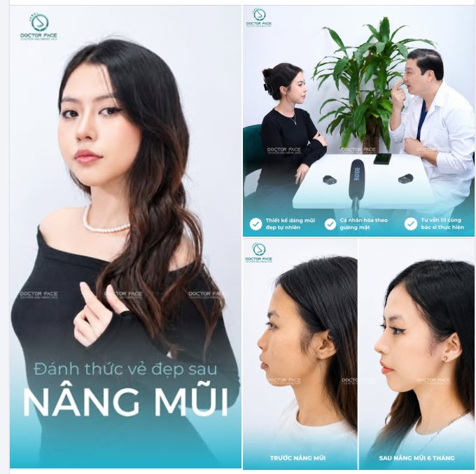 “Mình đã tìm hiểu rất kỹ suốt hơn 2 tháng trước khi quyết định về Việt Nam làm mũi, và đến hiện tại mình thấy quyết định này thật sự rất xứng đáng.”