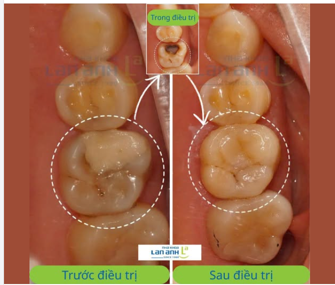 Đừng đợi miếng trám cũ "lên tiếng" mới thay.
