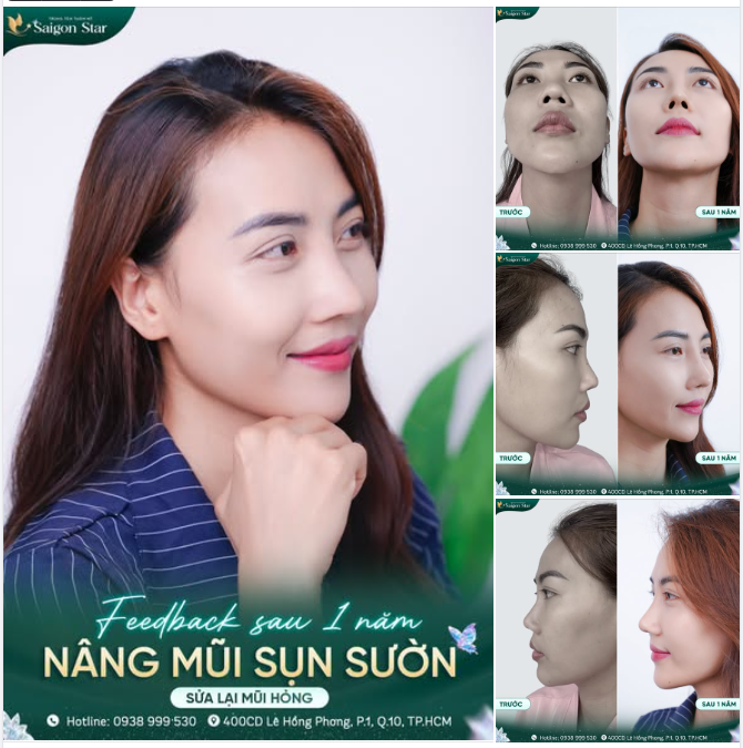 MŨI ĐẸP ỔN ĐỊNH SAU 1 NĂM SỬA LẠI MŨI HỎNG