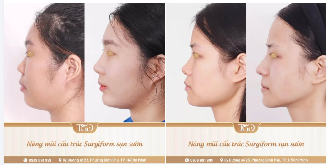 Không sao chép một khuôn mẫu - kiến tạo dáng mũi phù hợp cho từng gương mặt