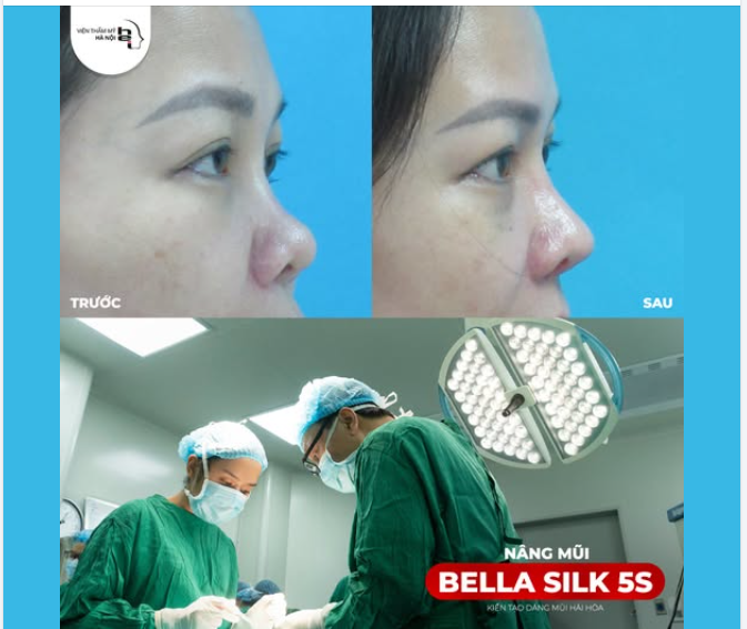 SỐNG MŨI THẤP? GƯƠNG MẶT THIẾU ĐIỂM NHẤN?