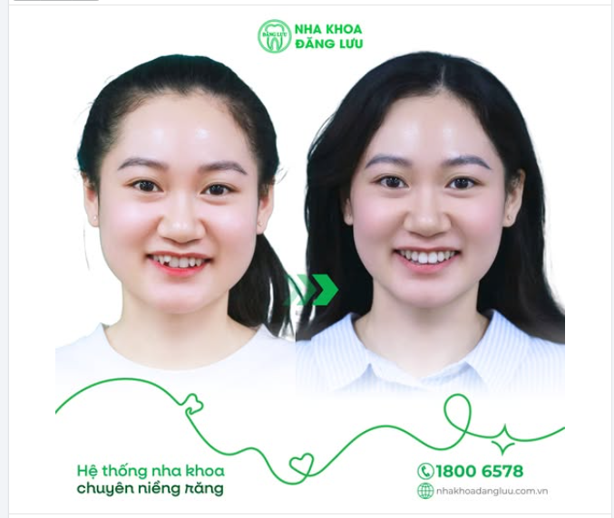 DẬY THÌ THÀNH... XINH ​​​​​​​  +1 nụ cười được "unlock" tại Nha Khoa Đăng Lưu
