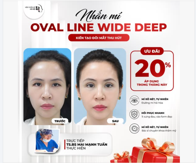 NHẤN MÍ OVAL LINE WIDE DEEP