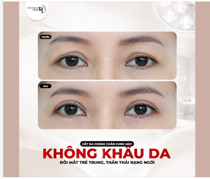 SỢ SẸO VÙNG MẮT? CHECK NGAY CÔNG NGHỆ CẮT DA CHÙNG CHÂN MÀY KHÔNG KHÂU DA ĐỈNH CAO!