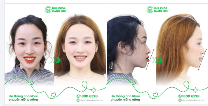 "Unlock" Góc Nghiêng Điện Ảnh Sau Niềng Chỉ Với 2,5 Năm Cùng Nha Khoa Đăng Lưu
