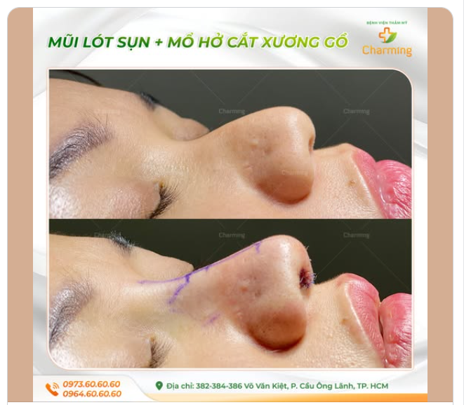 Ngoài phần sống mũi bè, có điểm gồ, đầu mũi to, phần xương ở cánh mũi to bè khiến gương mặt như ngắn hơn và chưa được hài hòa.