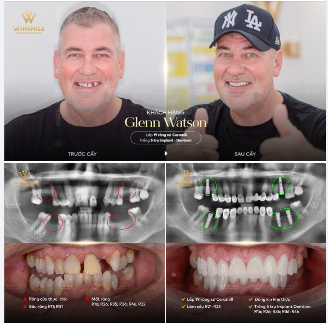 GLENN WATSON * HÀNH TRÌNH THAY ĐỔI NỤ CƯỜI Ở TUỔI 62