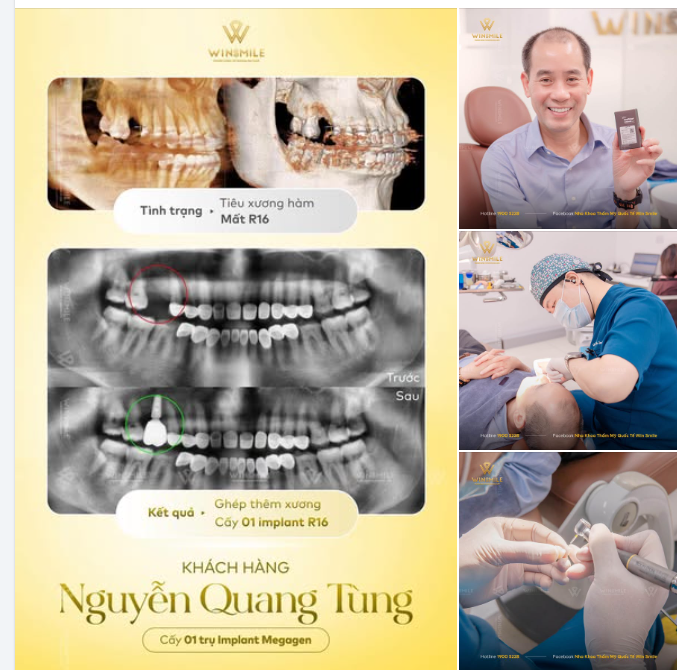 PHỤC HỒI RĂNG SỐ 16 - TÌM LẠI CẢM GIÁC ĂN NHAI