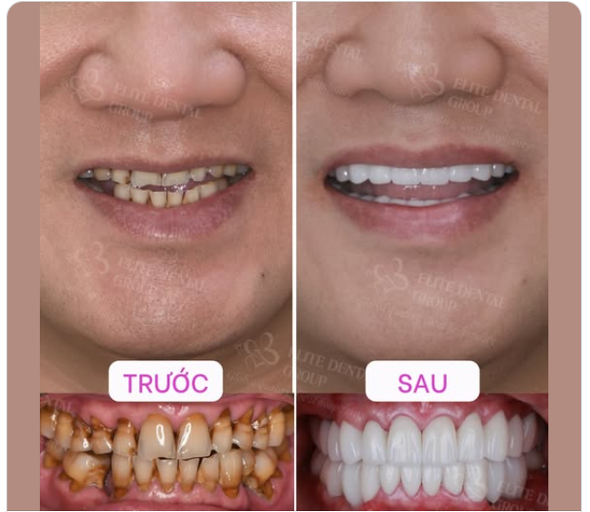 VỀ NƯỚC LÀM RĂNG, THỜI GIAN ĐIỀU TRỊ KHÔNG CÒN LÀ NỖI LO