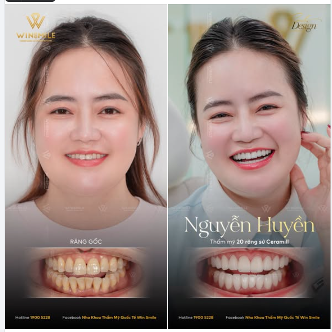 "Biết thế này chị làm răng từ lâu rồi"