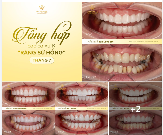 THÁNG 7 TẠI WIN SMILE: THAY ĐỔI MỘT NỤ CƯỜI, TÁI TẠO MỘT THẦN THÁI
