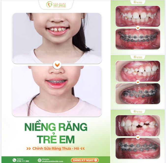 CHƯA MỌC HẾT RĂNG VĨNH VIỄN – NIỀNG RĂNG ĐƯỢC KHÔNG?