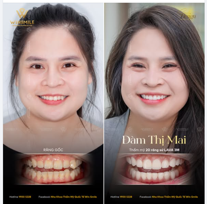 Trở về từ Dubai với khao khát định hình lại hình ảnh cá nhân, chị Mai tìm đến Win Smile không phải để "sửa" khuyết điểm, bởi nền răng nguyên bản của chị vốn đã khá đều đặn.