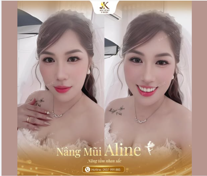 Nâng mũi Aline – Nâng tầm nhan sắc, tỏa sáng trong ngày trọng đại.