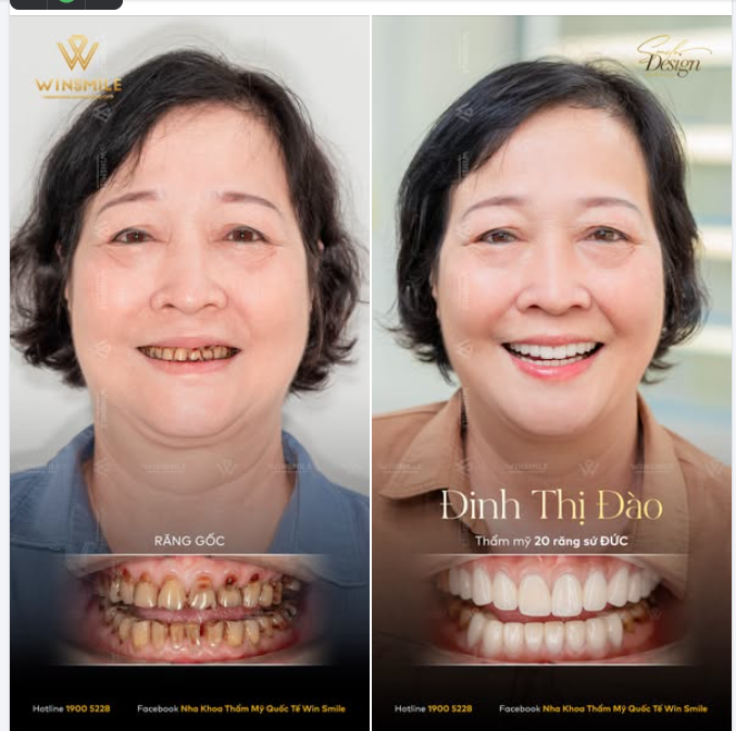 Chị Đào tìm đến Win Smile khi nụ cười đã chịu quá nhiều tổn thương từ thời gian.