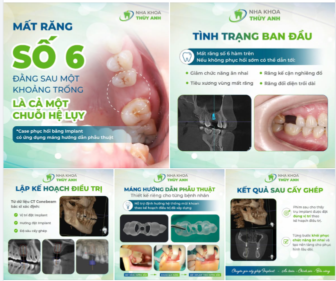 MẤT RĂNG SỐ 6 – ĐẰNG SAU MỘT KHOẢNG TRỐNG LÀ CẢ MỘT CHUỖI HỆ LỤY