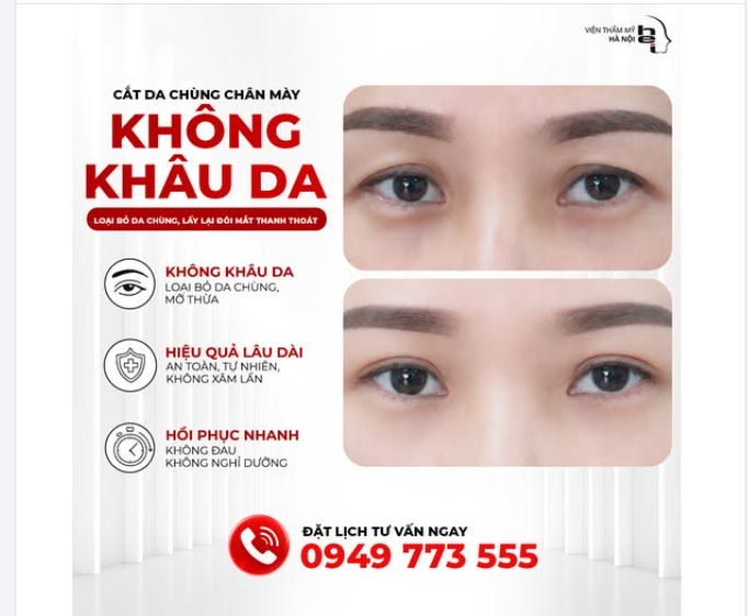 Bạn có biết tác hại của hiện tượng Da chùng mí mắt