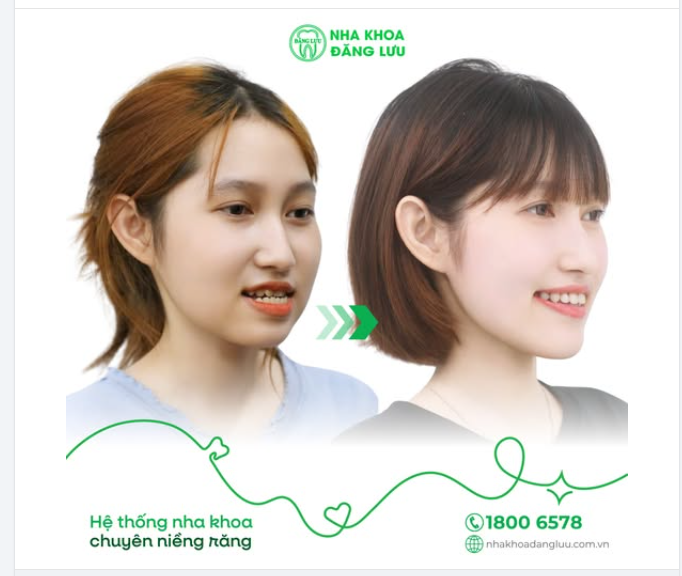 DẬY THÌ THÀNH... XINH  Có những màn "dậy thì" không đến từ tuổi tác, mà đến từ ngày tháo niềng.