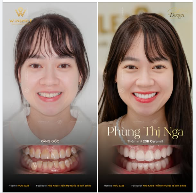 Sự tinh tế trong thẩm mỹ nụ cười là khi tìm ra được tỷ lệ hài hoà và phù hợp nhất với diện mạo của mỗi người