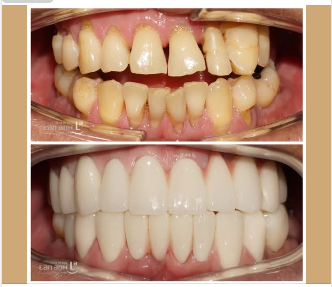 Từ một hàm răng tổn thương nặng đến một khớp cắn ổn định.