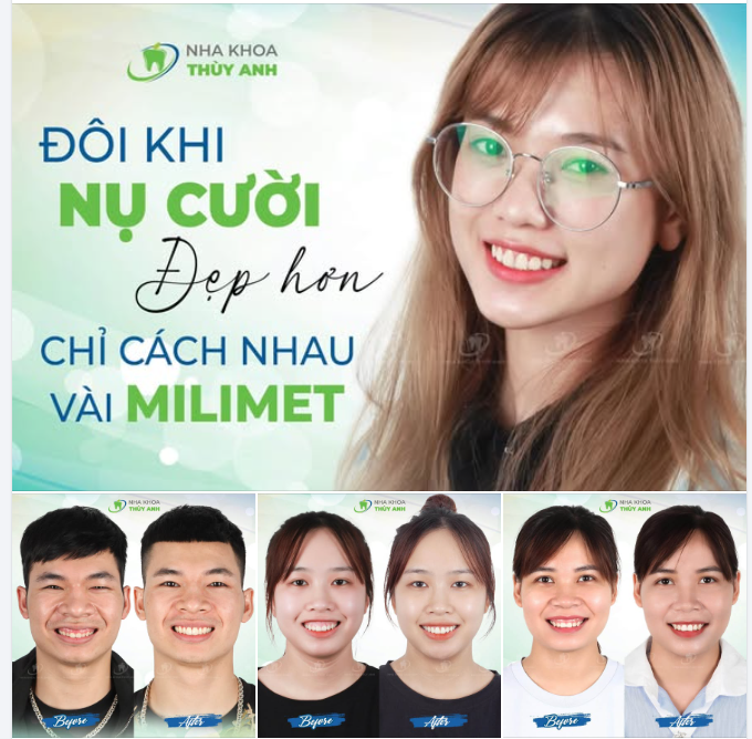 ĐÔI KHI, NỤ CƯỜI ĐẸP HƠN CHỈ CÁCH NHAU VÀI MILIMET