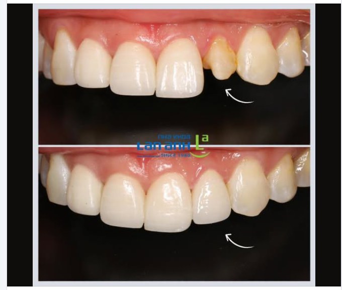 Đây không chỉ là một ca răng sứ đẹp.