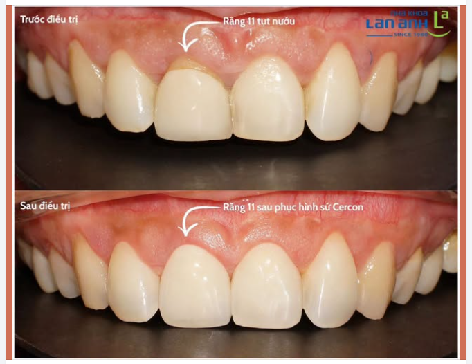 Tụt nướu làm lộ cổ răng,  Ai nhìn cũng bảo: “Sao răng dài ghê?”