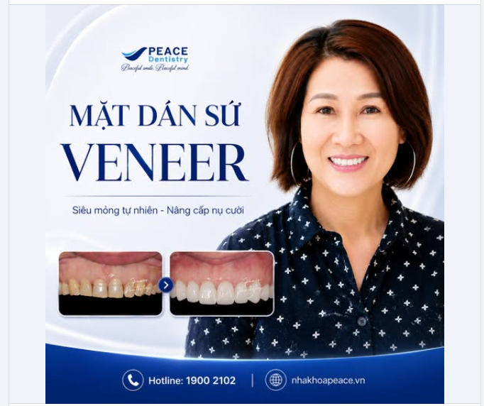 DÁN SỨ VENEER: VẺ ĐẸP CÁ NHÂN HÓA