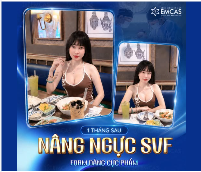 1 THÁNG SAU NÂNG NGỰC SVF – FORM DÁNG CỰC PHẨM
