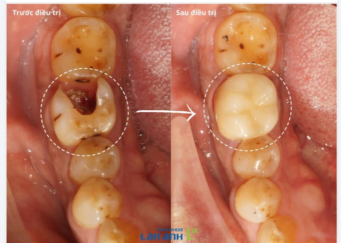Răng sâu lớn → Chữa tủy → Bọc mão sứ  Đây là "bộ ba" giúp bảo tồn răng thật hiệu quả.