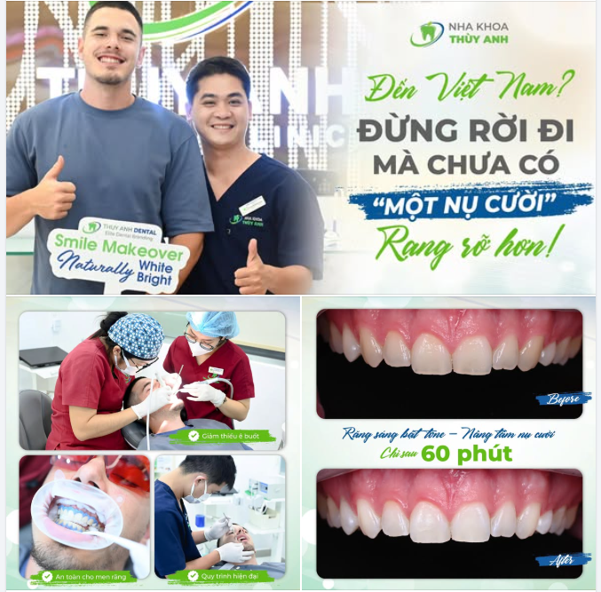 ĐIỀU MÌNH MONG CHỜ NHẤT SAU NIỀNG KHÔNG PHẢI RĂNG ĐỀU, MÀ LÀ KHỚP CẮN ĐƯỢC CẢI THIỆN!