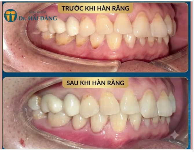Nguyễn Đình Dương – HÀN RĂNG PHỤC HỒI