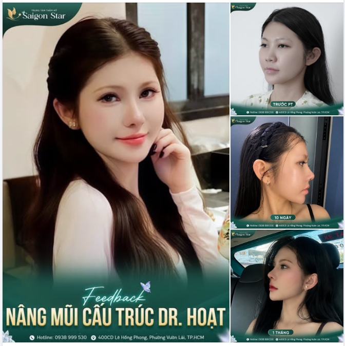 CÙNG SAIGON STAR "CHECK" XEM SAU 1 THÁNG NÂNG MŨI THÌ CÓ GÌ THAY ĐỔI NHÉ