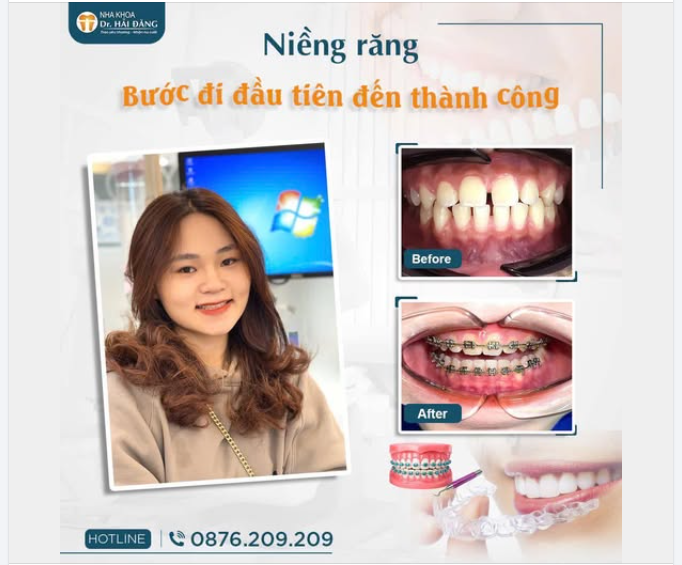 NIỀNG RĂNG – BƯỚC ĐI ĐẦU TIÊN ĐẾN THÀNH CÔNG
