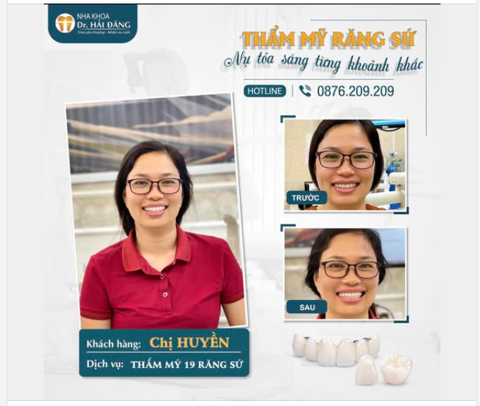 HẨM MỸ 19 RĂNG SỨ - HÀNH TRÌNH KIẾN TẠO NỤ CƯỜI HOÀN HẢO