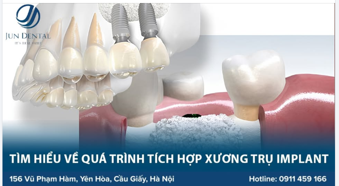 ​​​​​​​ Thời gian tích hợp xương thường kéo dài từ 2 – 6 tháng tùy vào cơ địa, chất lượng xương hàm và cách chăm sóc của mỗi người.