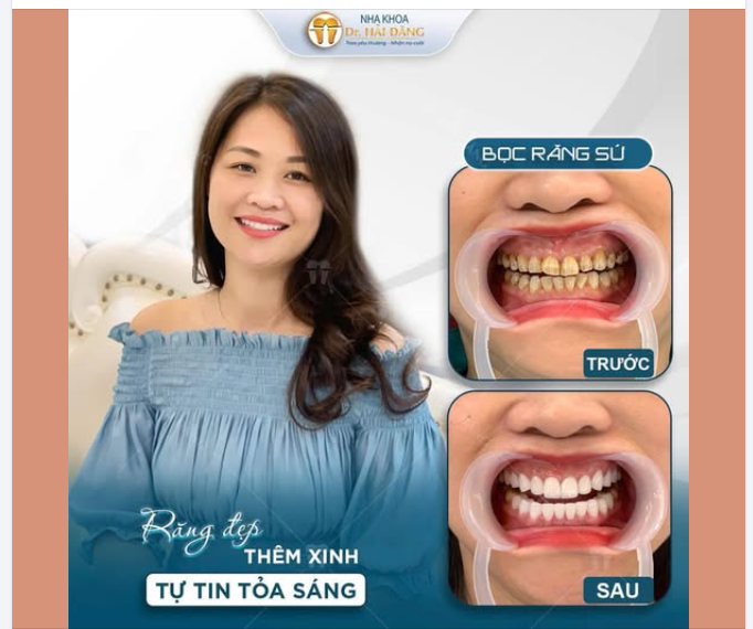 TRƯỚC VÀ SAU BỌC RĂNG SỨ - KHÁC BIỆT KHIẾN AI CŨNG BẤT NGỜ