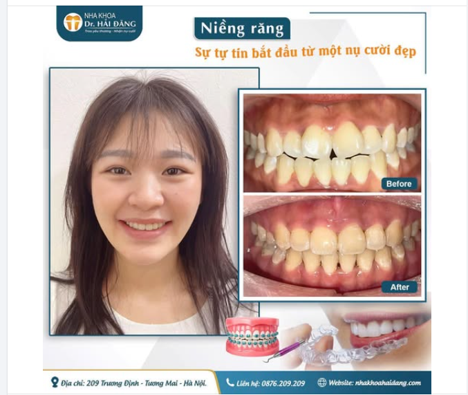 NIỀNG RĂNG – ĐẦU TƯ CHO NỤ CƯỜI, THAY ĐỔI CẢ SỰ TỰ TIN