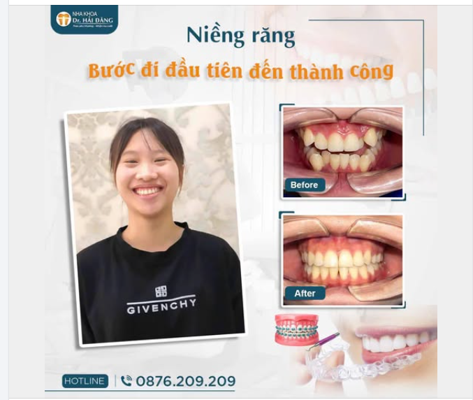 NIỀNG RĂNG – BƯỚC ĐI ĐẦU TIÊN ĐẾN THÀNH CÔNG