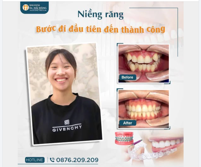 NIỀNG RĂNG – BƯỚC ĐI ĐẦU TIÊN ĐẾN THÀNH CÔNG