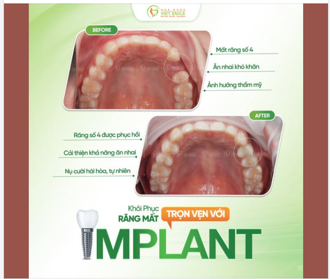 MẤT RĂNG SỐ 4 – KHÔI PHỤC VỮNG CHẮC VỚI IMPLANT