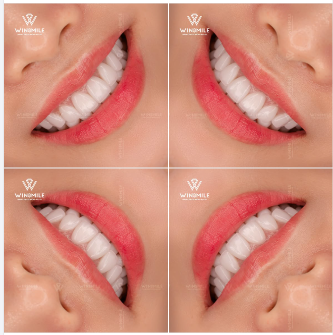 Đừng ngần ngại yêu thương nụ cười của mình theo cách dịu dàng nhất. Nếu bạn đang tìm kiếm một sự thay đổi mà không phải đánh đổi, hãy để Win Smile lắng nghe câu chuyện của bạn nhé!