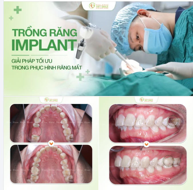 MẤT RĂNG SỐ 6 – KHÔI PHỤC ĂN NHAI VỮNG CHẮC VỚI IMPLANT