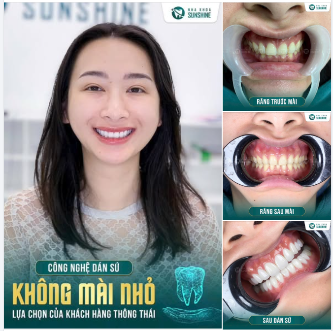 CẢI THIỆN NỤ CƯỜI BẰNG DÁN SỨ VENEER – GIẢI PHÁP BẢO TỒN RĂNG THẬT TỐI ĐA.