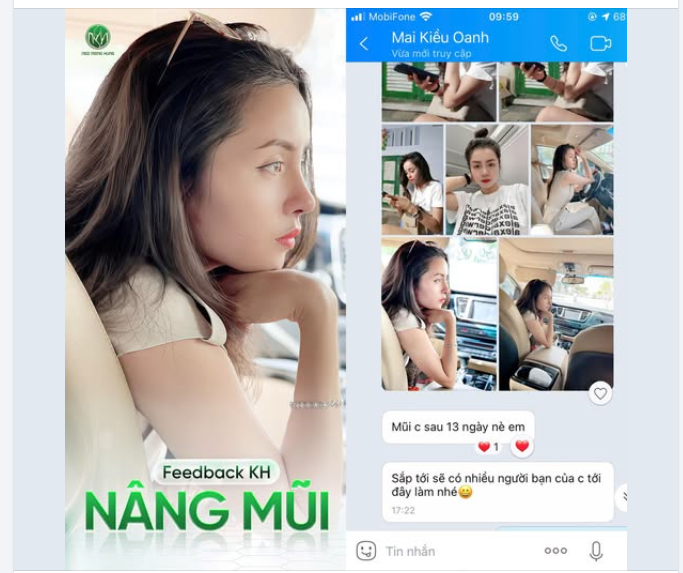 Feedback nâng mũi 13 ngày tuổi